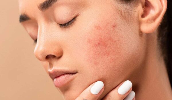 چگونه جای جوشهای فرورفته را با آرایش بپوشانیم: توصیههای یک آرایشگر حرفهای