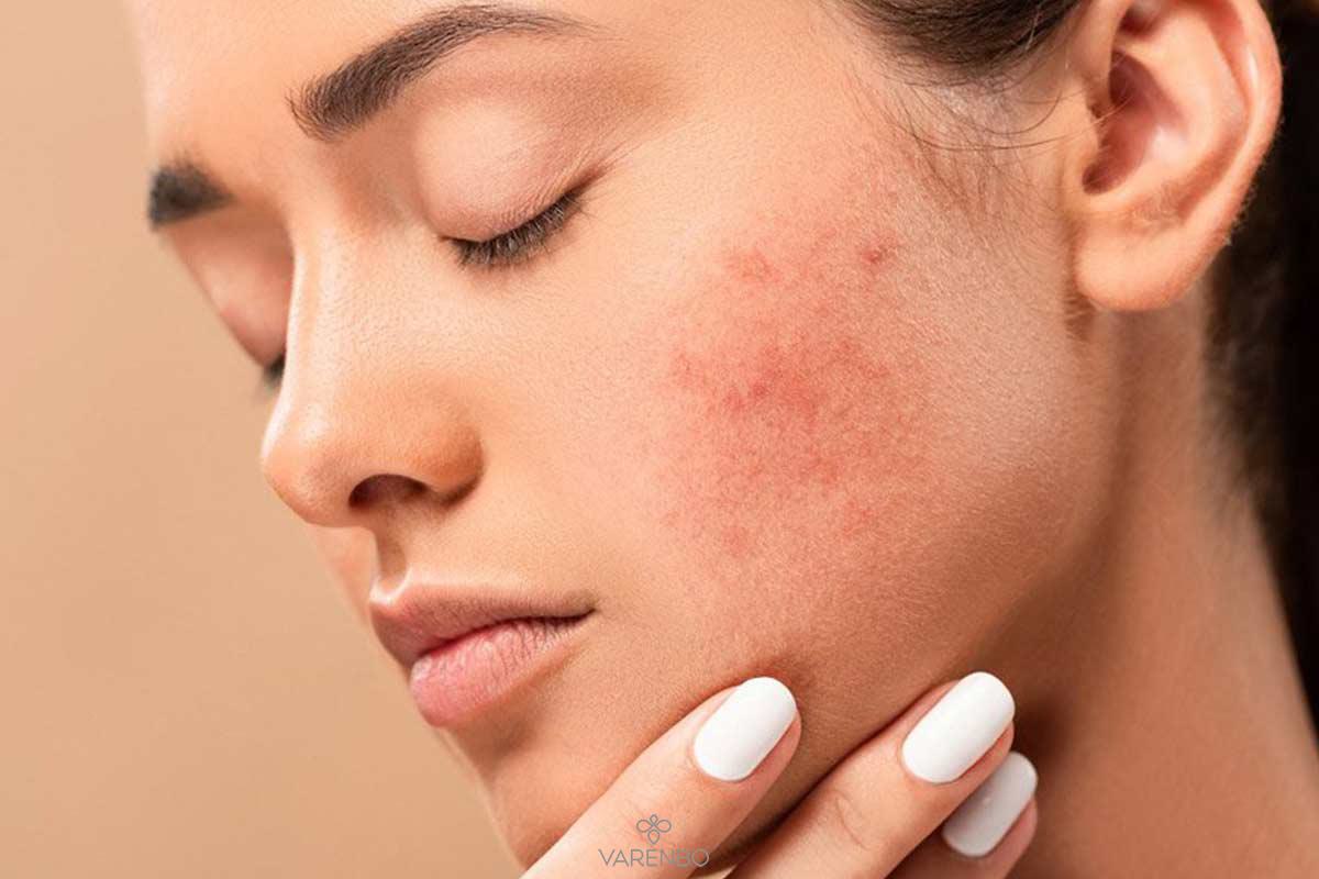 چگونه جای جوشهای فرورفته را با آرایش بپوشانیم: توصیههای یک آرایشگر حرفهای